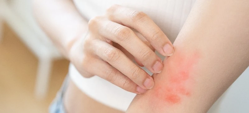 DrAxeContactDermatitisHeader DrAxeContactDermatitisHeader