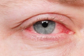red eye virus red eye virus
