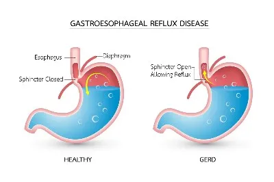 gastroesophageal reflux disease gastroesophageal reflux disease