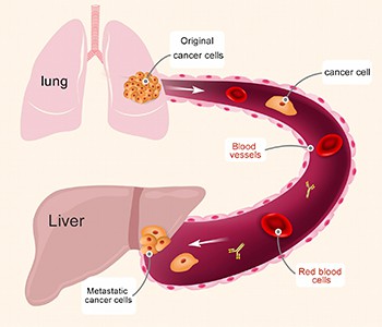 अगर आपको कैंसर है तो डरो मत। कैंसर कोशिकाओं के विकास को रोकने के लिए बस ये 4 ...
